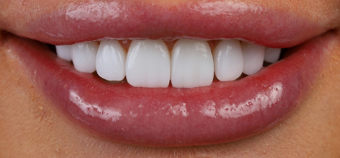 After: Kristin's smile with no-prep veneers