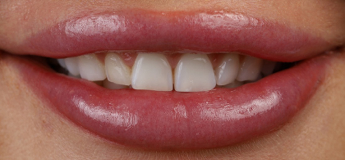 Before: Kristin's natural smile